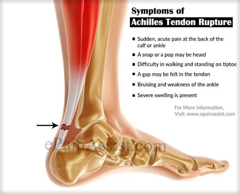 symptoms of ruptured achilles tendon